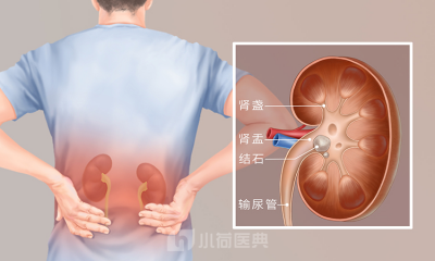 ​肾结石会引起身体哪个部位疼痛(肾结石哪里疼？)