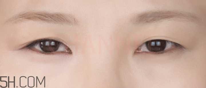 黑眼圈怎么去除既简单有容易 看类型与程度