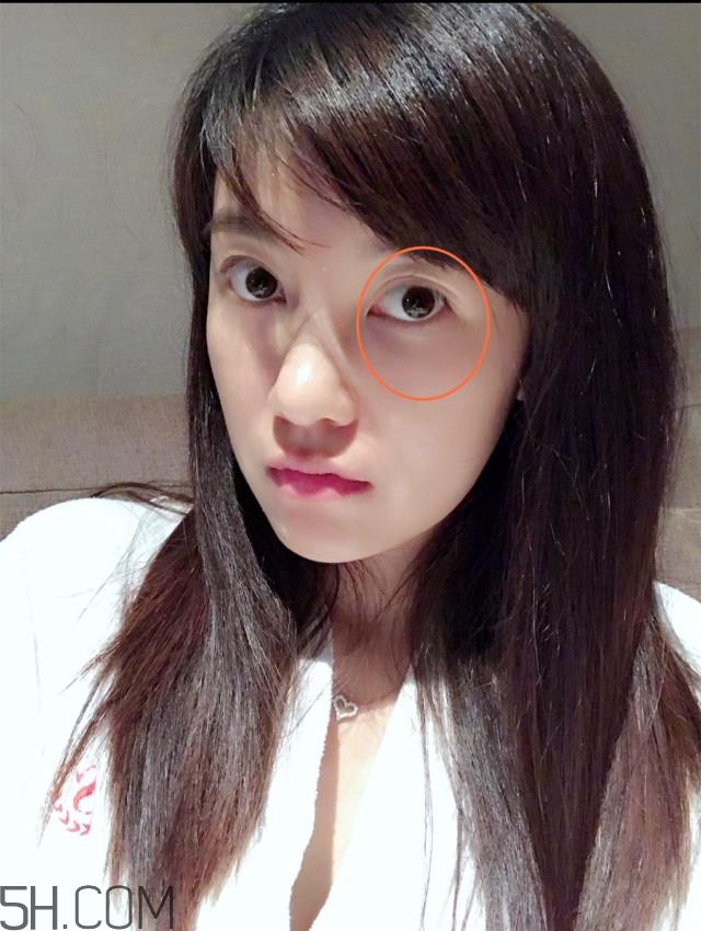 黑眼圈怎么去除既简单有容易 看类型与程度