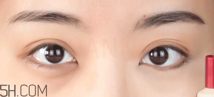 黑眼圈怎么去除既简单有容易 看类型与程度