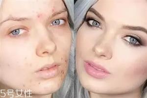 脸上长痘痘如何化妆 痘痘肌化妆的注意事项 脸上长痘痘如何化妆 痘痘肌化妆的注意事项