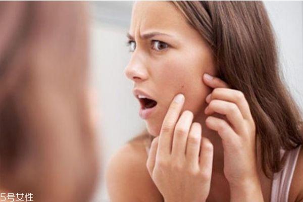 干皮为什么还长痘 干皮长痘痘的原因