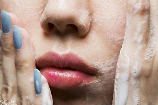 干皮为什么还长痘 干皮长痘痘的原因