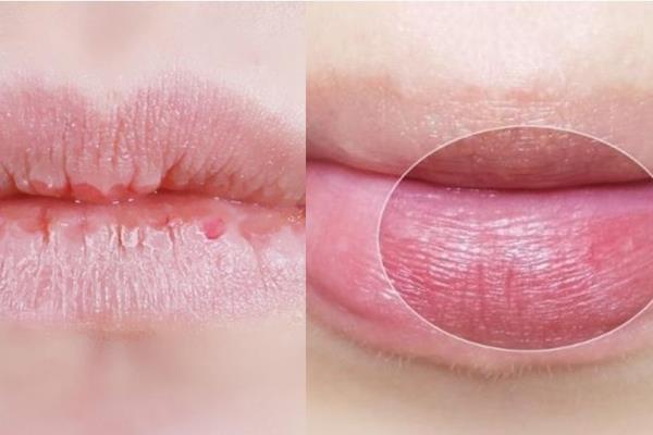 如何去除嘴部死皮 教你不伤嘴唇的方式 如何去除嘴部死皮 教你不伤嘴唇的方式