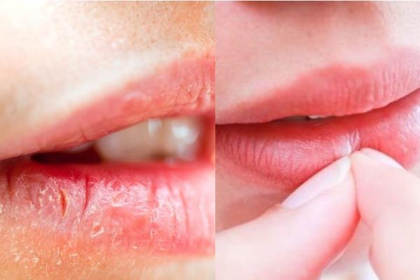 如何去除嘴部死皮 教你不伤嘴唇的方式 如何去除嘴部死皮 教你不伤嘴唇的方式
