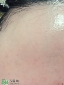 ​去闭口粉刺日常护肤步骤 去闭口小妙招