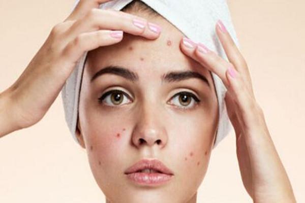 痘印消失的时间跟肤色有关吗 痘印要多久能消除 痘印消失的时间跟肤色有关吗 痘印要多久能消除