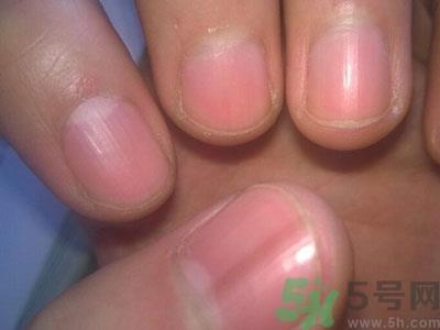 指甲上有竖纹是怎么回事?指甲上有竖纹吃什么好 指甲上有竖纹是怎么回事?指甲上有竖纹吃什么好