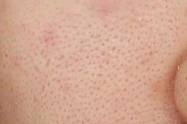 毛孔粗大有黑头怎么办 毛孔粗大能修复吗