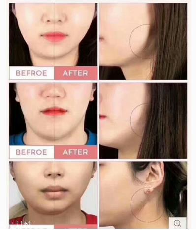 韩国dodo label隐形瘦脸贴敏感肌能用吗 注意事项