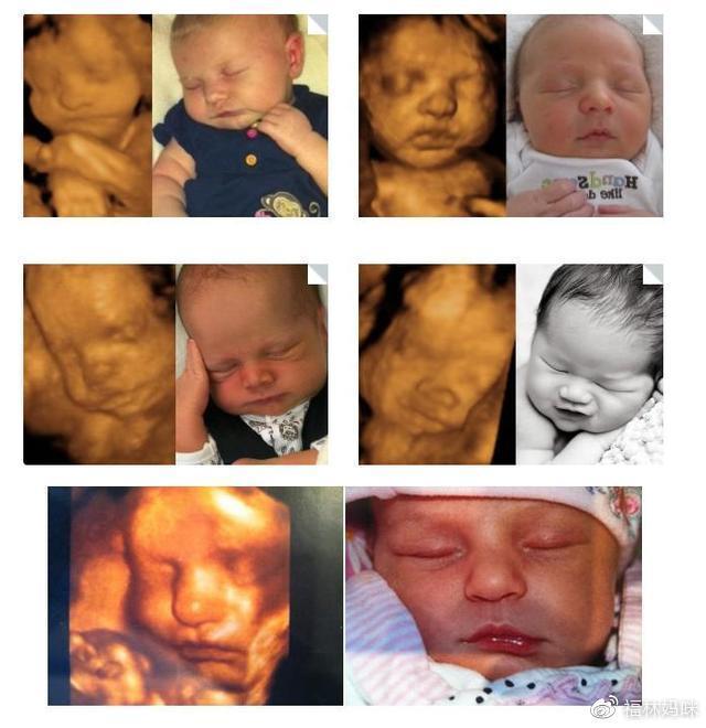 四维彩超跟实际长相有没有差别?宝妈:当初高鼻梁,出来塌鼻梁