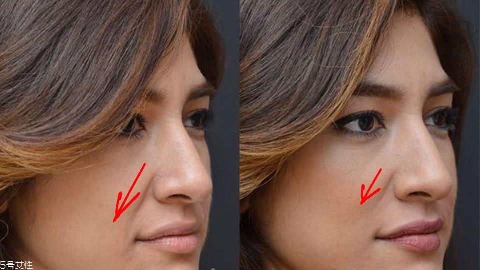 法令纹怎么按摩手法 睡前3步骤帮你摆脱水肿脸 法令纹怎么按摩手法 睡前3步骤帮你摆脱水肿脸