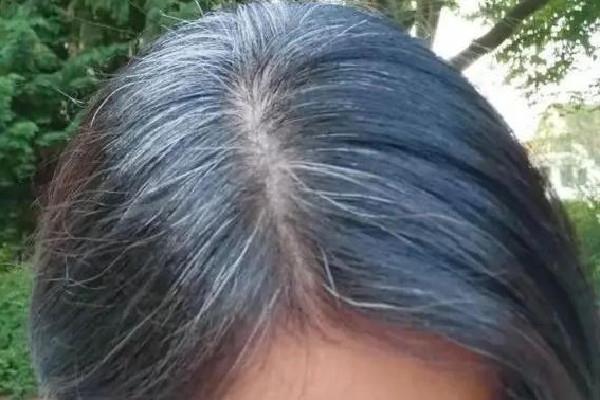 白头发越来越多是身体哪里有问题 白头发多和肾虚有关系吗 白头发越来越多是身体哪里有问题 白头发多和肾虚有关系吗