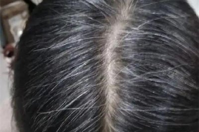 白头发越来越多是身体哪里有问题 白头发多和肾虚有关系吗