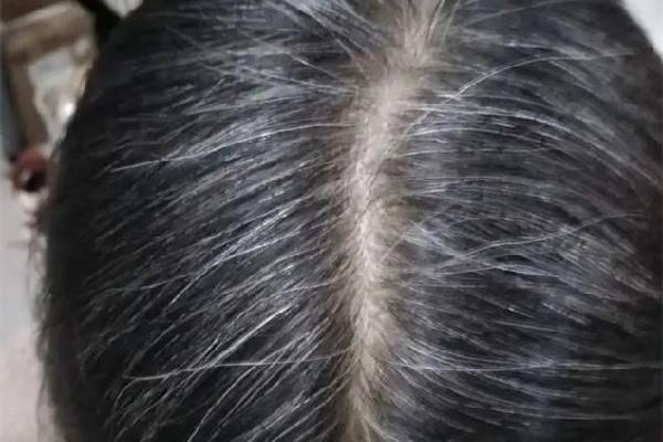白头发越来越多是身体哪里有问题 白头发多和肾虚有关系吗 白头发越来越多是身体哪里有问题 白头发多和肾虚有关系吗