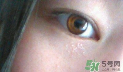 眼霜可以去除脂肪粒吗?眼霜可以消除脂肪粒吗?