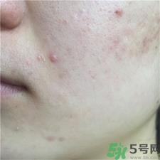 宝拉珍选水杨酸有用吗?宝拉水杨酸怎么样? 宝拉珍选水杨酸有用吗?宝拉水杨酸怎么样?