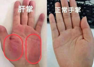 肝掌会自己消失吗?快去看看你的手掌,杨主任教你如何辨别