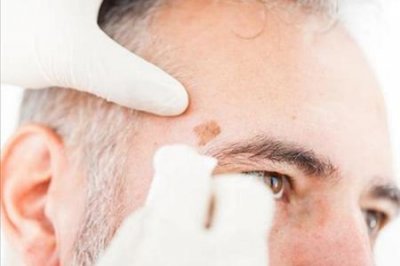 身体出现老年斑什么原因(背上长老年斑怎么回事)