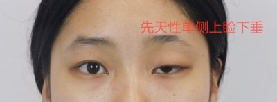 ​上睑下垂是什么原因造成的？是“因为医院在接生时的失误引起”？