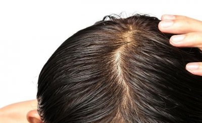 头发油腻是什么原因(原因竟然有这么多)