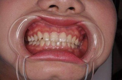 牙齿松动怎么办教你一招自愈(牙齿松动别急着拔)