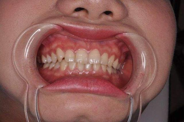 牙齿松动怎么办教你一招自愈(牙齿松动别急着拔)(1)