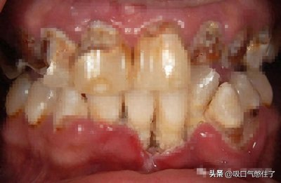 ​冰毒嘴！这样的影像片子可要注意啦！一图识别是否吸毒！