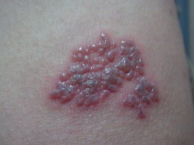 疱疹怎么治疗呢?(疱疹怎么治疗能去根)