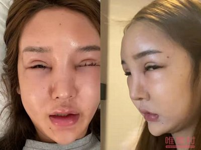 ​网红桃花宝宝整容失败 脸简直吓死人