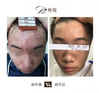 ​脸上痤疮粉刺 痤疮和粉刺有什么区别？患上痤疮饮食方面需要忌口吗