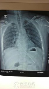 ​惊险！他吞下了一根18厘米的毛衣针……