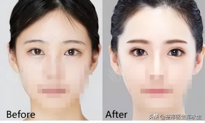 ​科普｜解密近两年流行爆红的眼睑下至